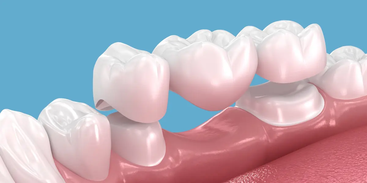 Dental crowns and bridges treatment