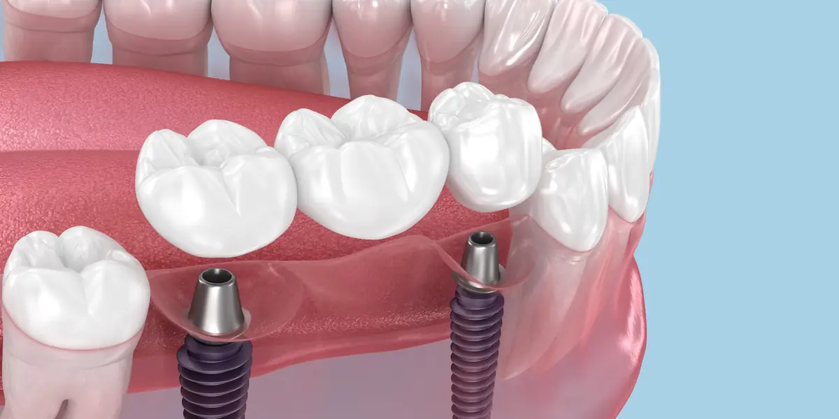 Dental implant procedure - Permanent tooth replacement