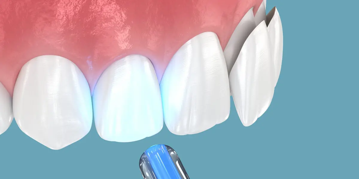Dental veneers - Perfect smile transformation