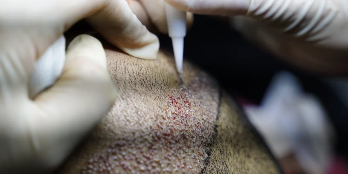 Sapphire FUE Hair Transplant