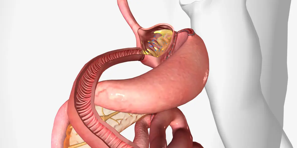 Gastric Bypass Surgery