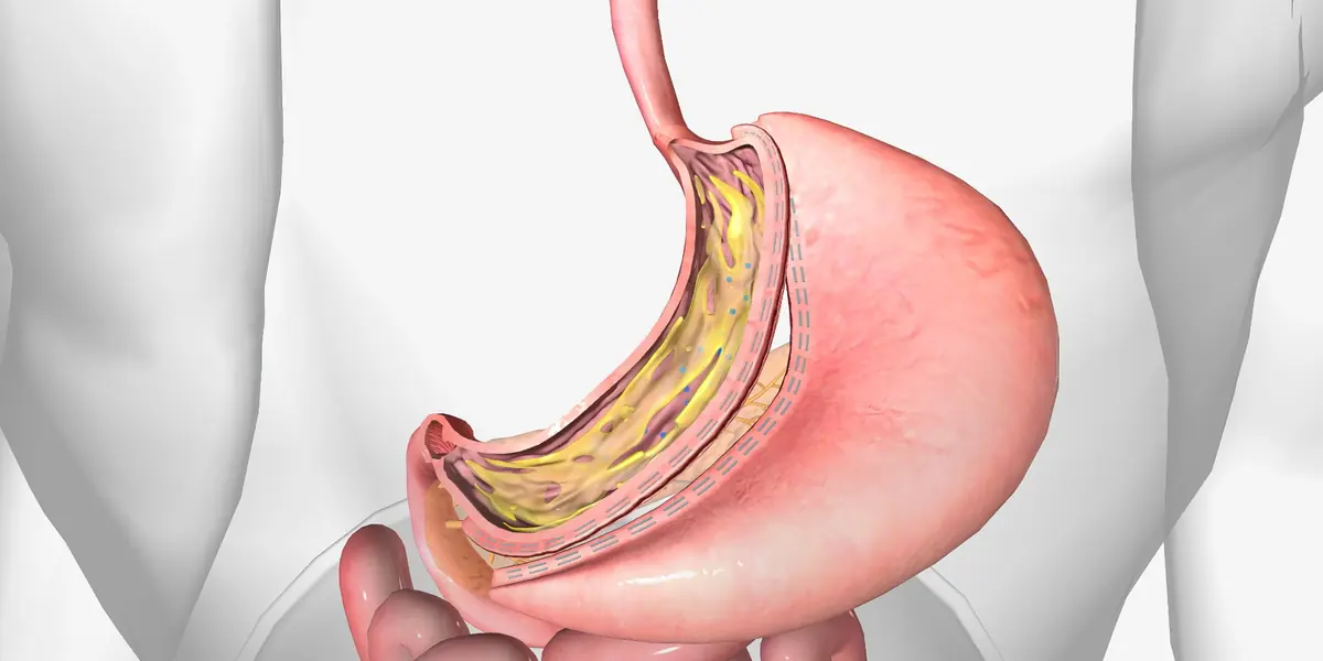 Gastric Sleeve Surgery