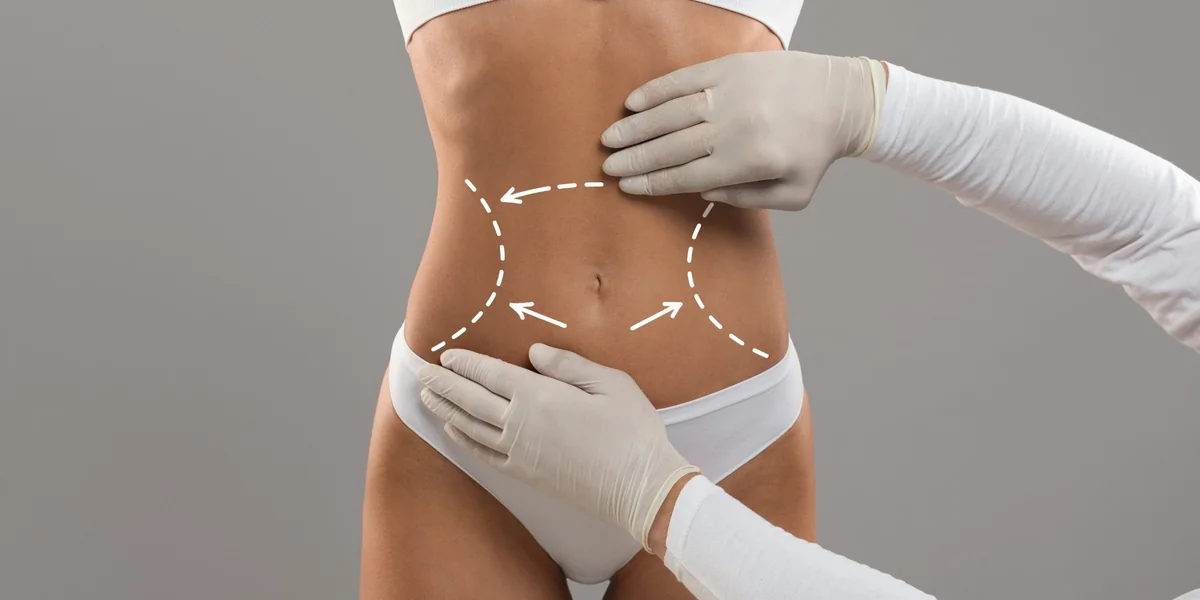 Liposuction