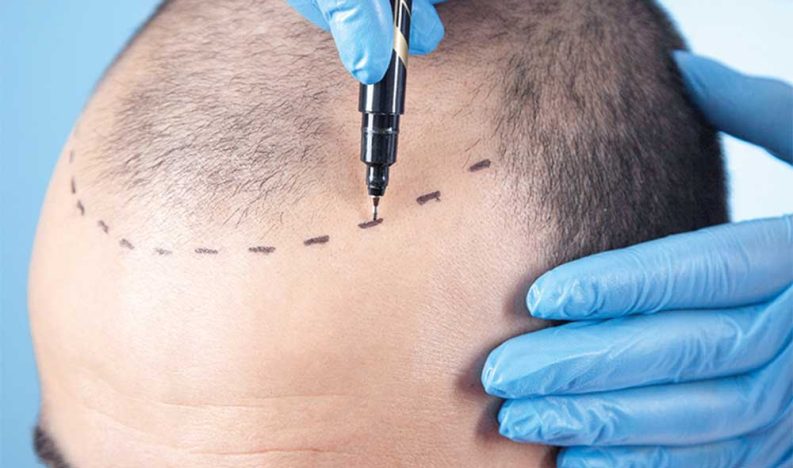 hair-transplantation-in-antalya hair-transplantation-in-antalya